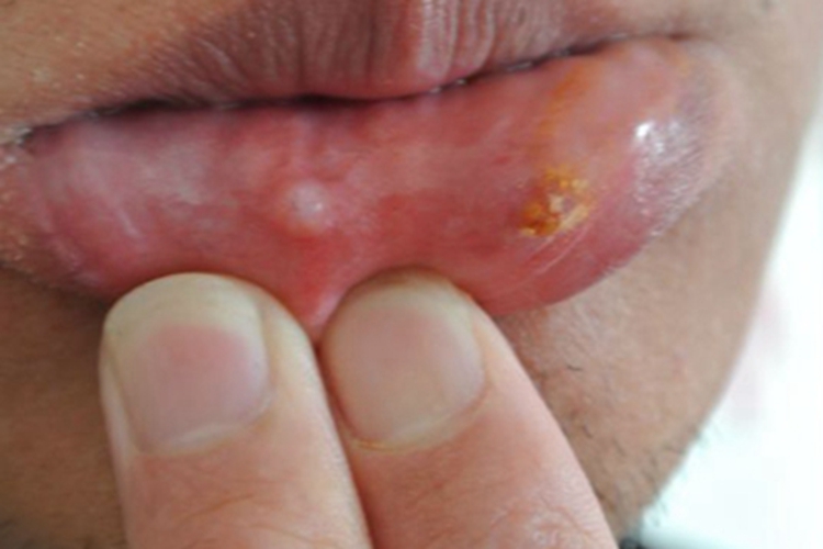 口腔疱疹溃疡图