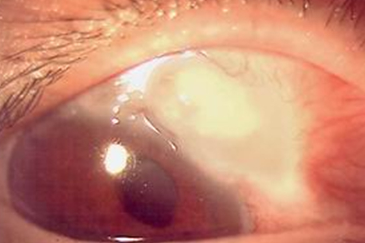 原发性青光眼图