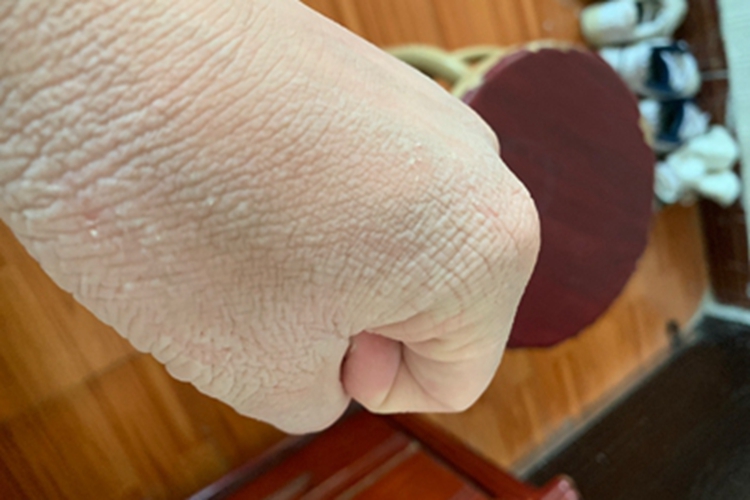 窝状角质松解症手背症状图