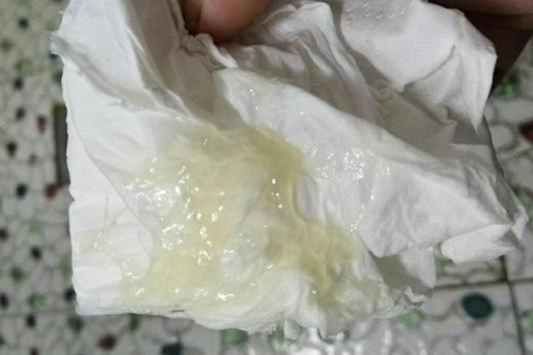 着床白带增多图