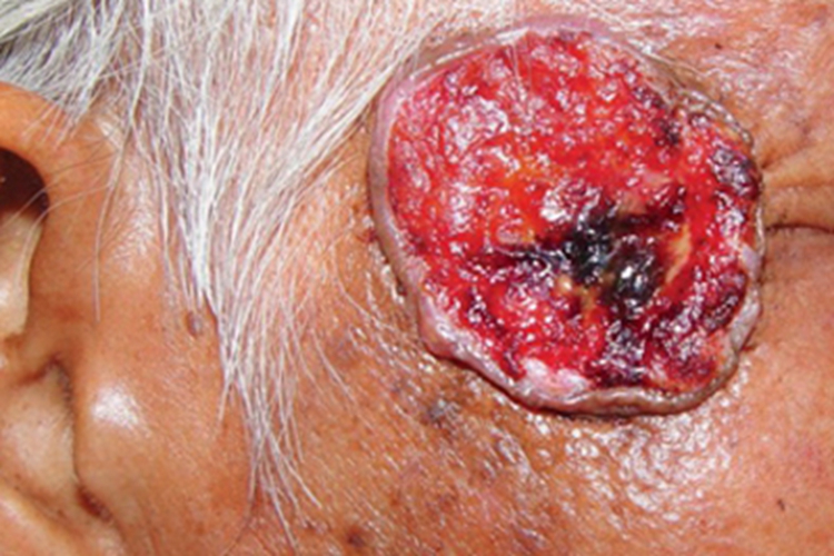 结节型基底细胞癌溃疡图 结节型基底细胞癌溃疡图