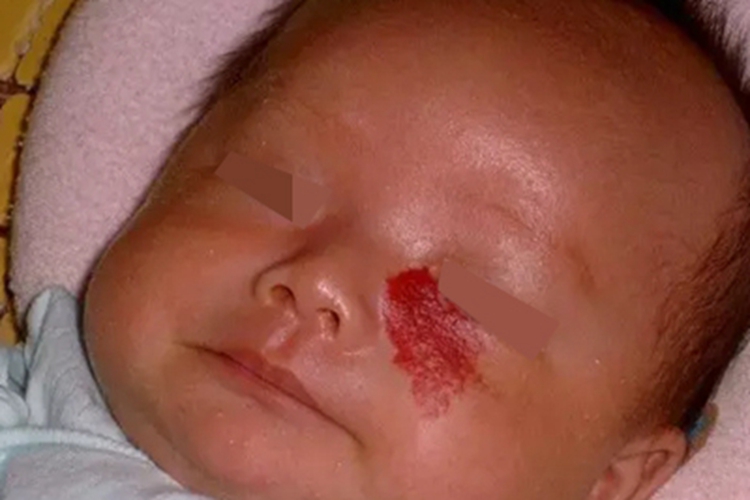 蔓状血管瘤面部症状图 蔓状血管瘤面部症状图