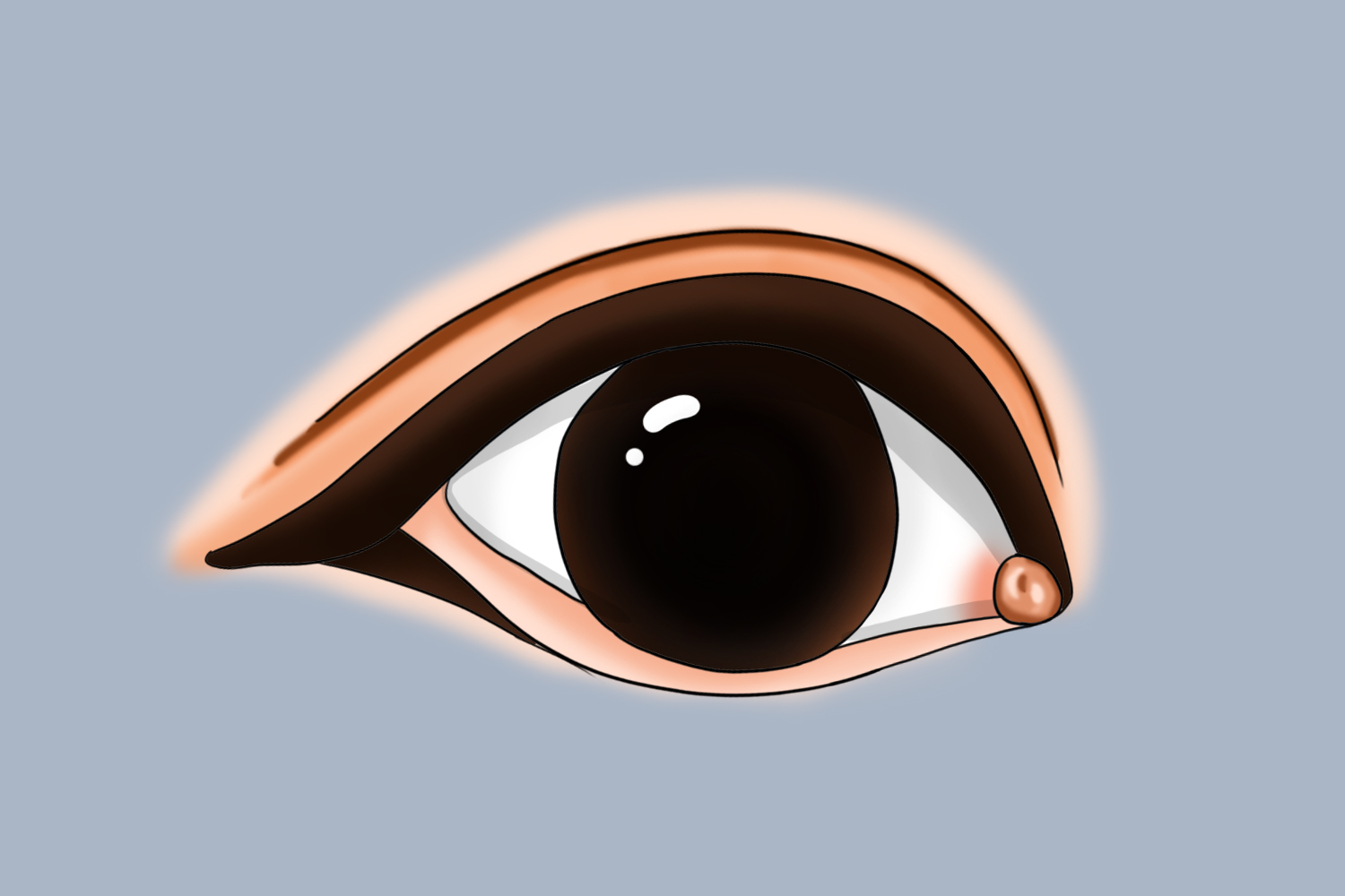 内眼角睑裂斑长了个黄疙瘩图