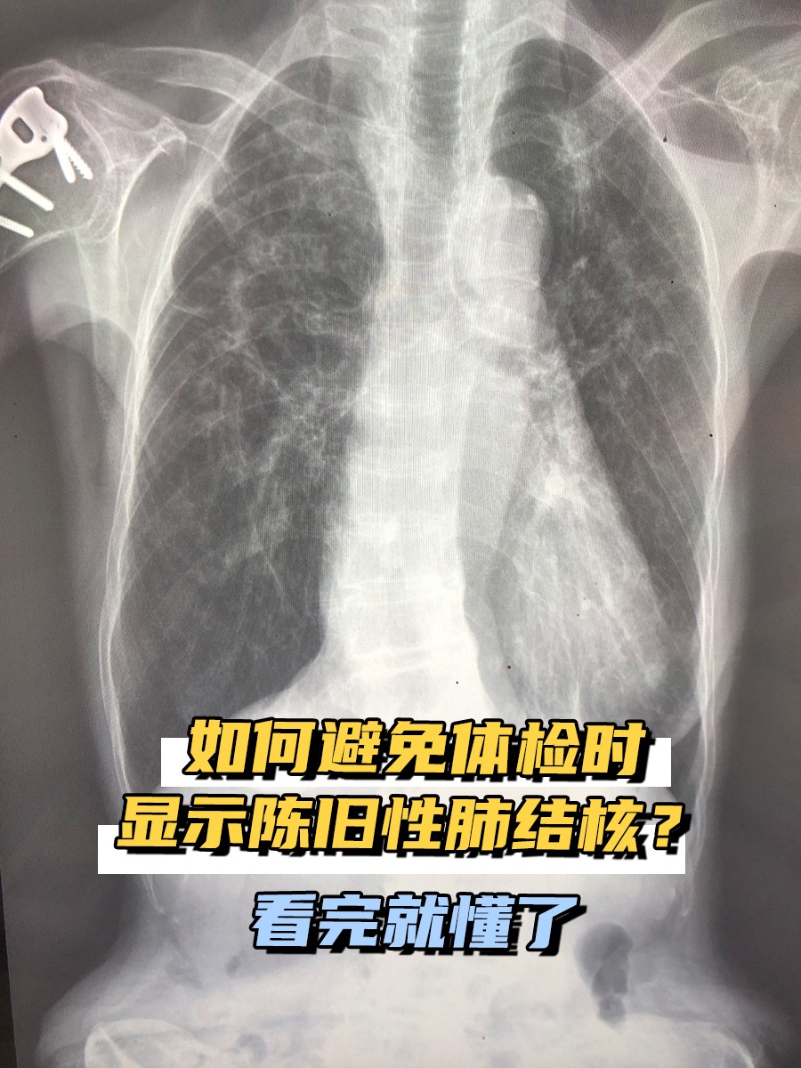 如何避免体检时显示陈旧性肺结核？看完就懂了