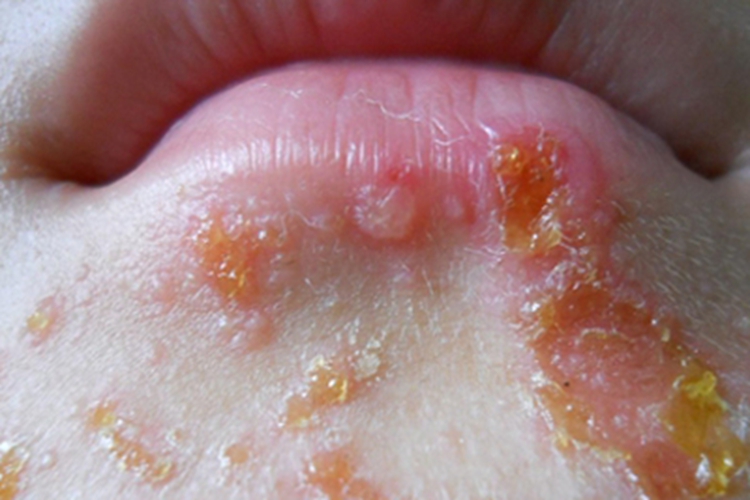 脓疱疮下巴黄痂图