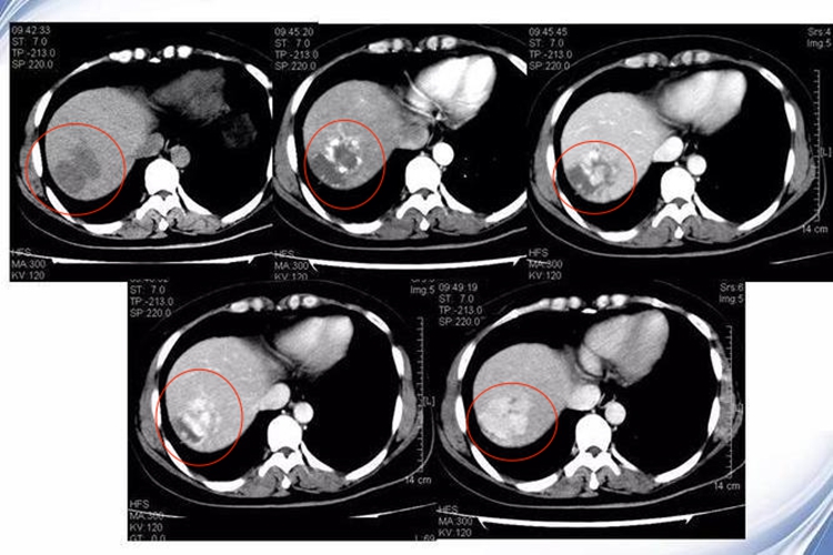 细菌性肝脓肿CT检查图
