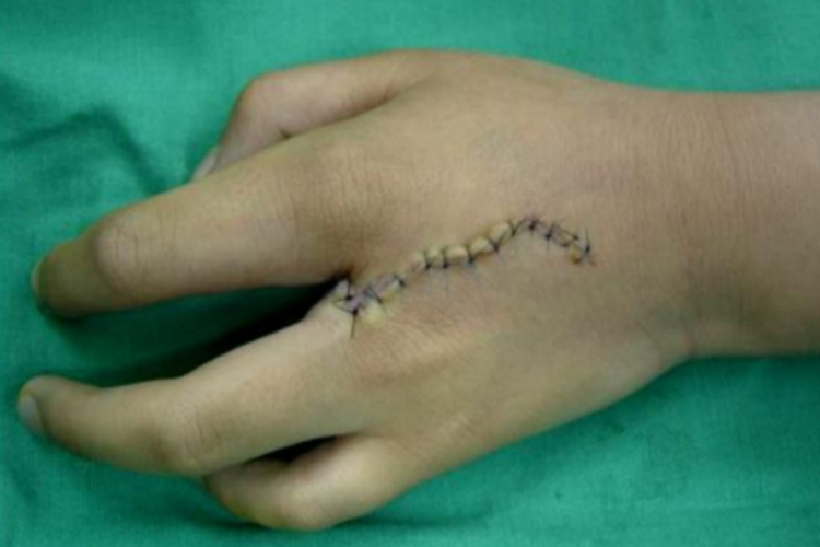 先天性手指缺失图 先天性手指缺失图