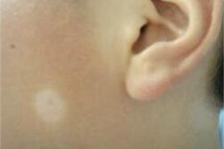 白癜风面部白斑图 白癜风面部白斑图