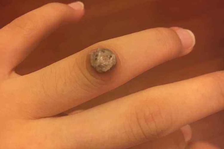 手部典型寻常疣图