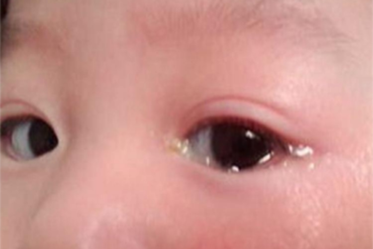 儿童结膜炎眼部症状图 儿童结膜炎眼部症状图