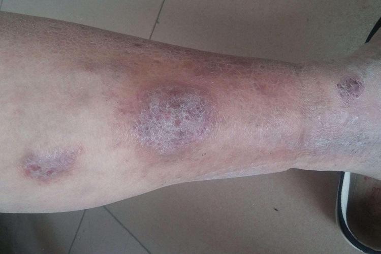 急性淤积性皮炎图