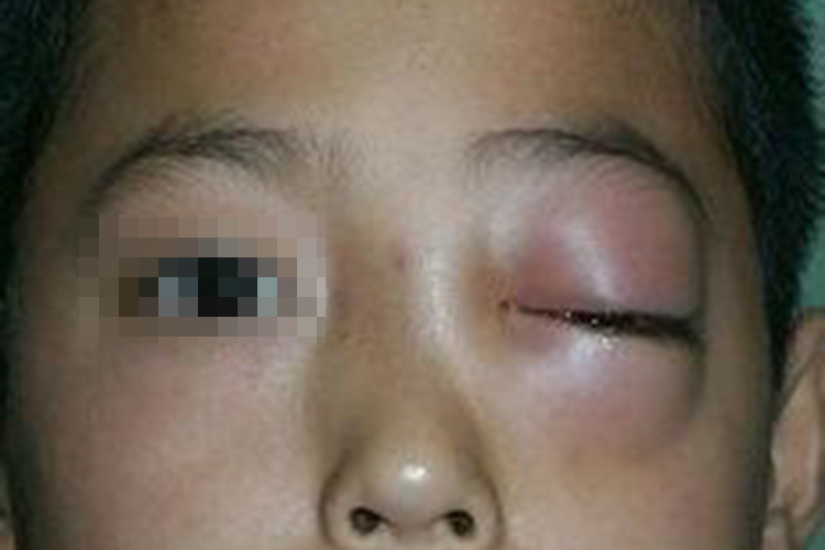 眼眶蜂窝织炎眼球突出图