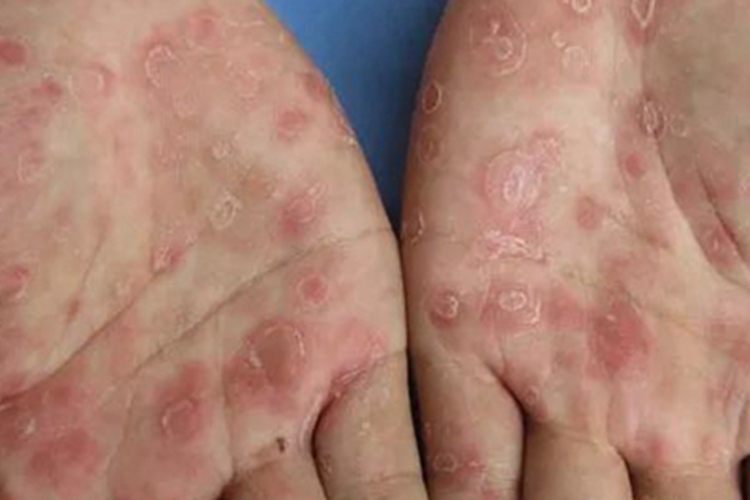 结节性梅毒疹红斑图