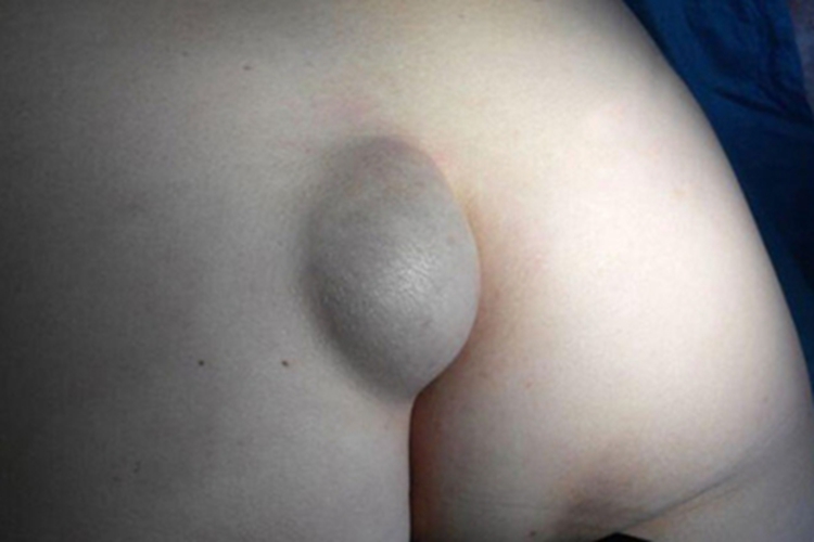 皮脂腺囊肿臀部大包图