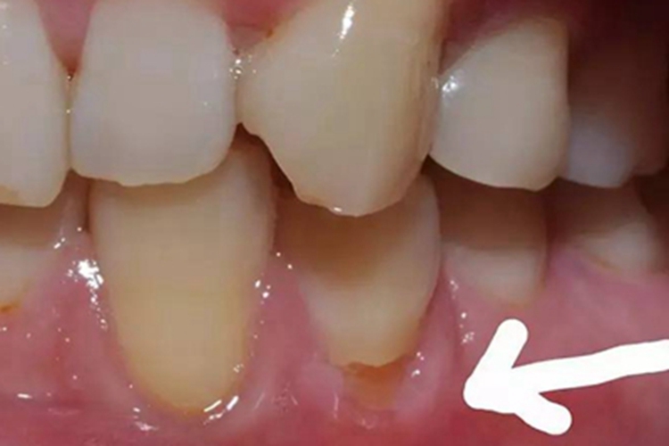 楔状缺损牙齿缺损图