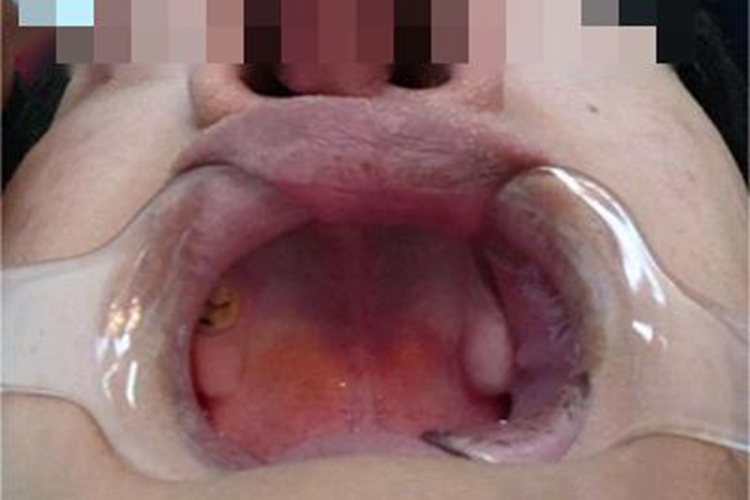 先天性外胚叶发育不良出牙延迟图 先天性外胚叶发育不良出牙延迟图