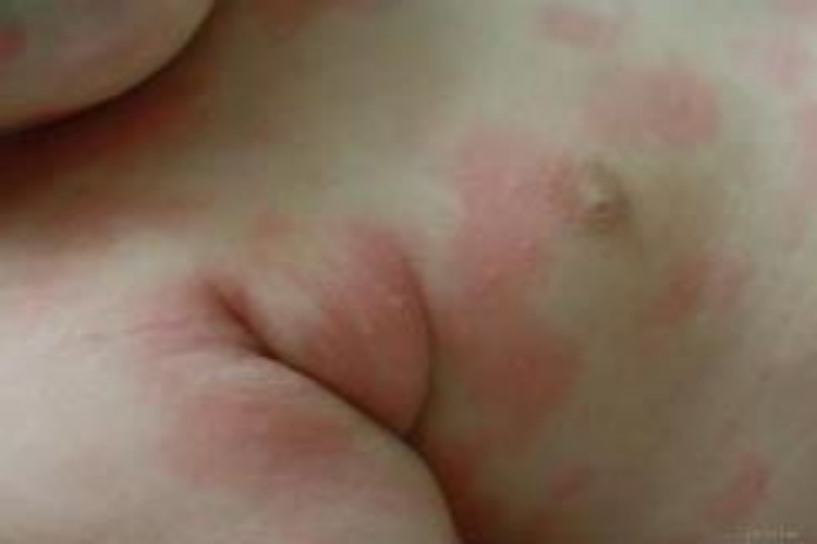 小儿头孢过敏固定性红斑药疹图