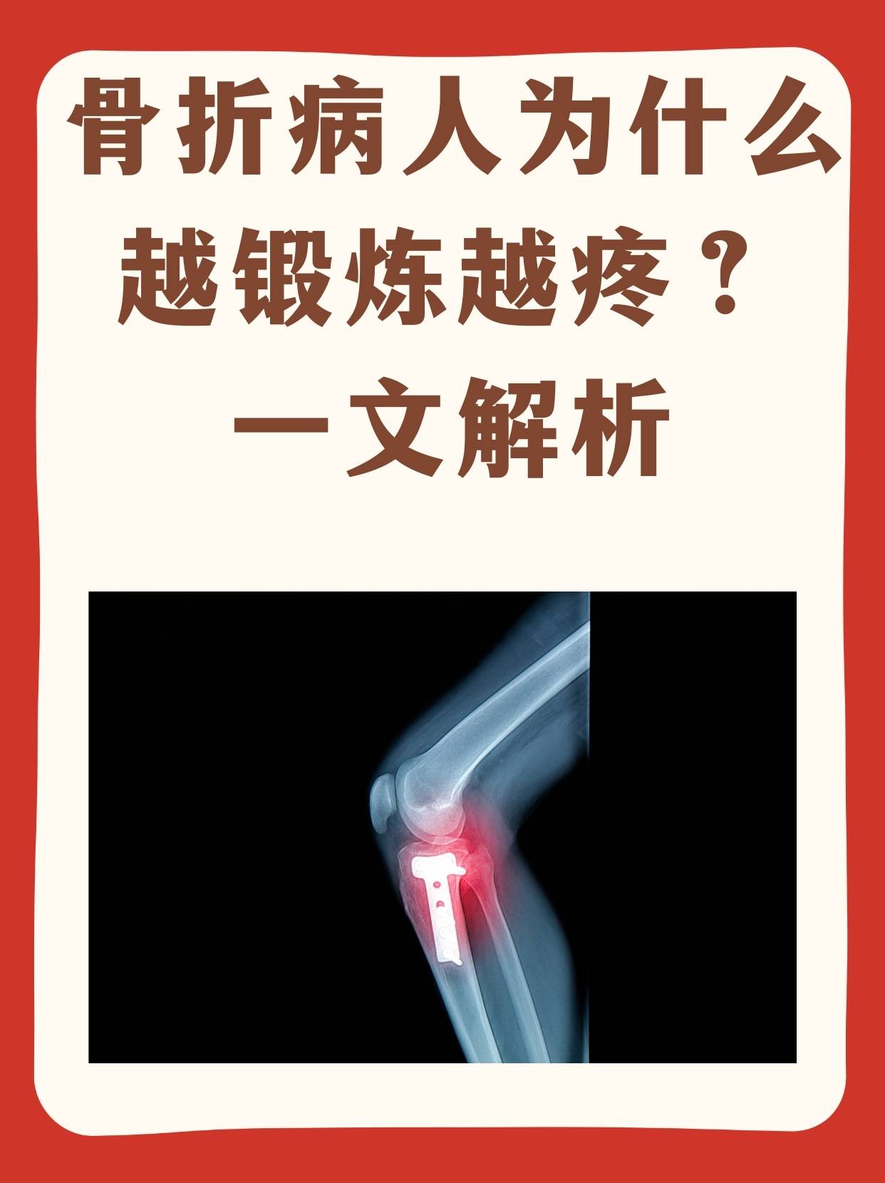 骨折病人为什么越锻炼越疼?一文解析