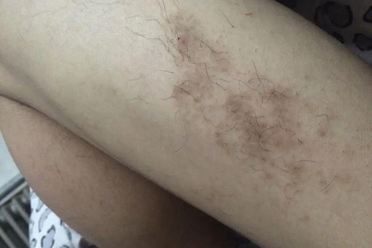 腿上黑色素沉着摩图