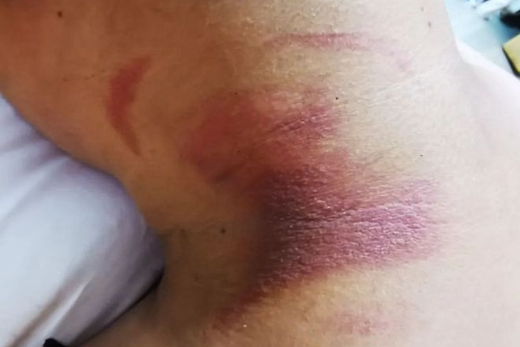 Ⅰ度烧伤后颈发紫图