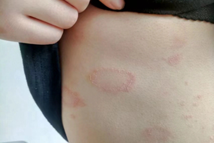 玫瑰糠疹肋部脱屑图 玫瑰糠疹肋部脱屑图