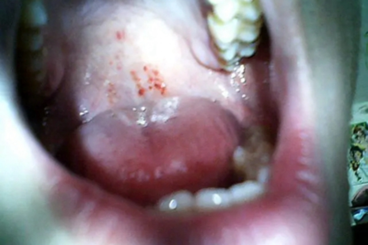 巨球蛋白血症性紫癜口腔血点图