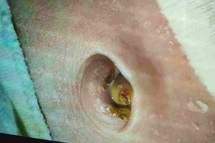 新生儿脐带白色肉芽图片