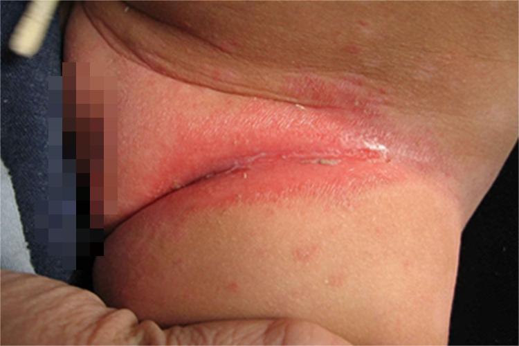 间擦疹大腿症状图