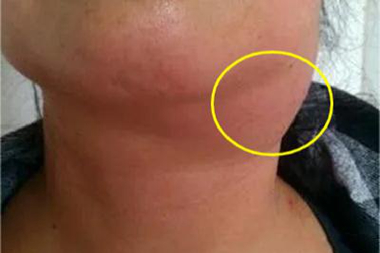 急性淋巴管炎大包图 急性淋巴管炎大包图