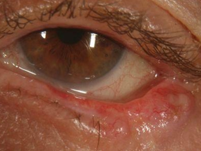 结膜鳞状细胞癌下眼睑肿胀伴有红血丝图.jpg
