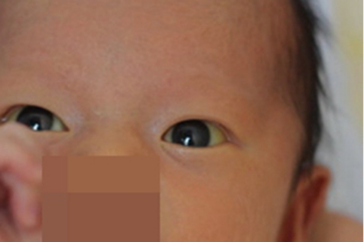 新生儿黄疸白眼球发黄图