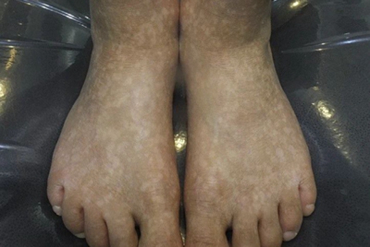 特发性点状色素减退斑脚背白斑图 特发性点状色素减退斑脚背白斑图