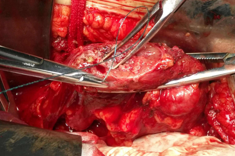 肾切除术图 肾切除术图