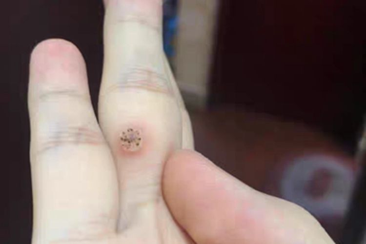 疣硬块图