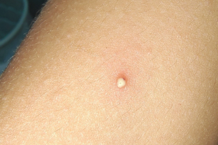 毛囊炎胳膊脓疱图