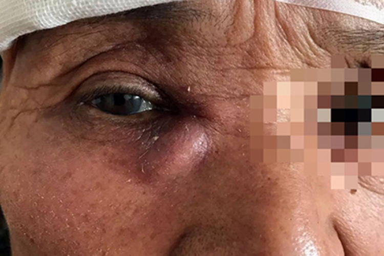 慢性泪囊炎眼角症状图