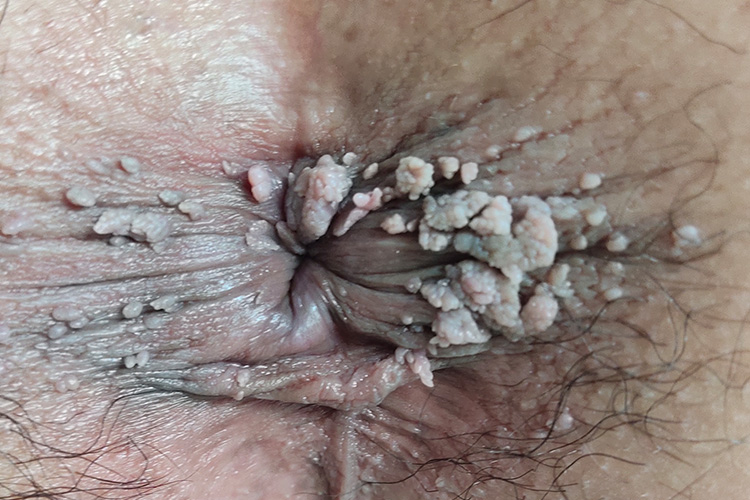 艾滋病肛周菜花样疣体图