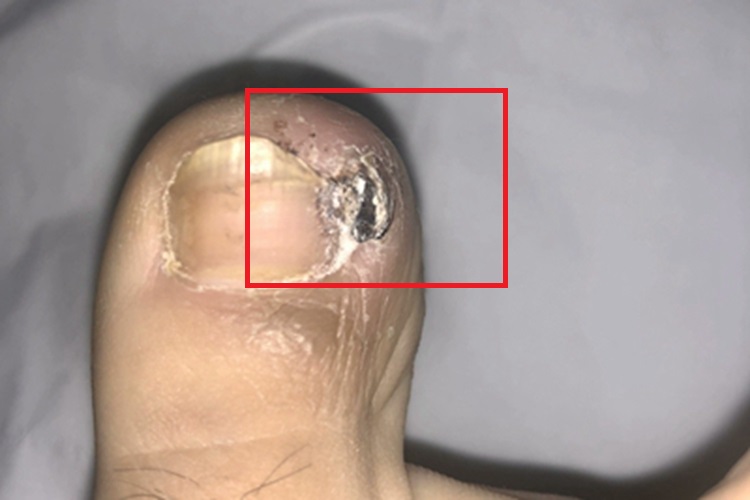 慢性甲沟炎脚趾血痂图 慢性甲沟炎脚趾血痂图