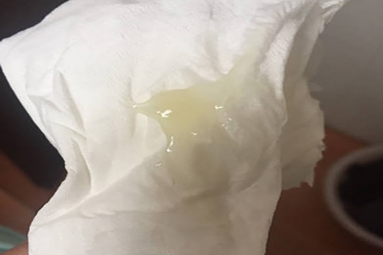 孕39周正常白色分泌物