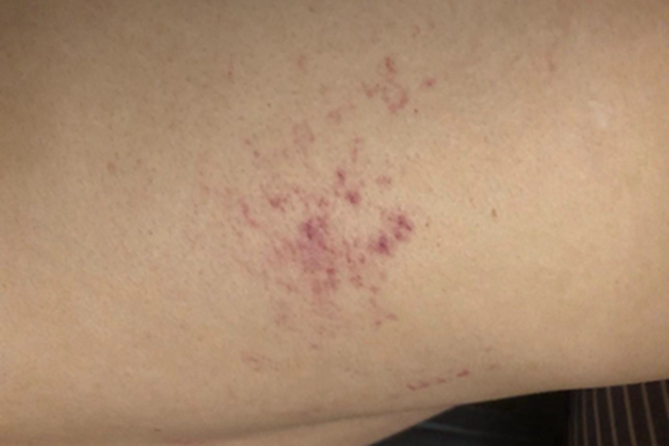 过敏性紫癜腿小红疙瘩图