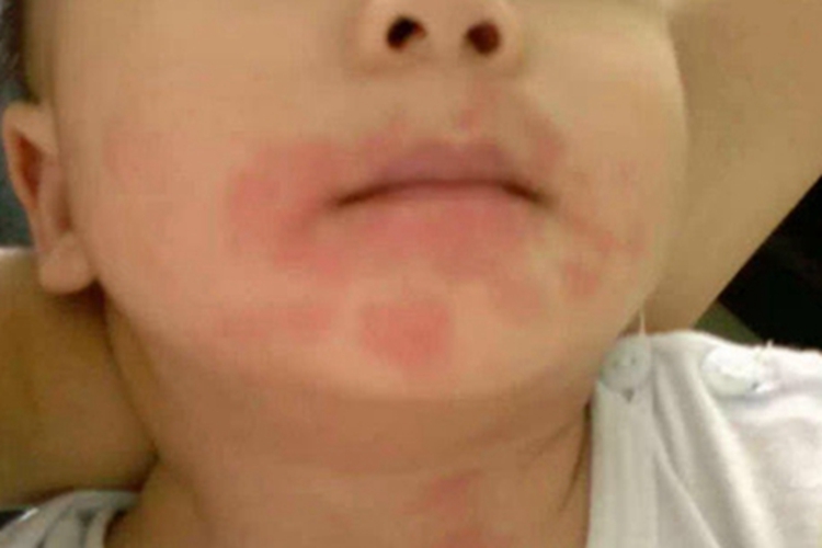 小儿海鲜过敏口周红斑图