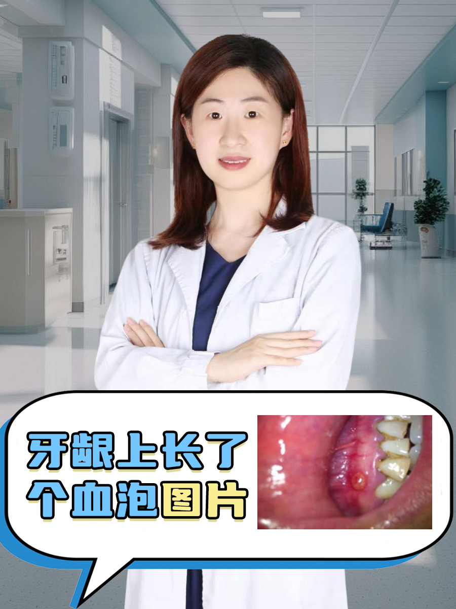牙龈上长了个血泡图片