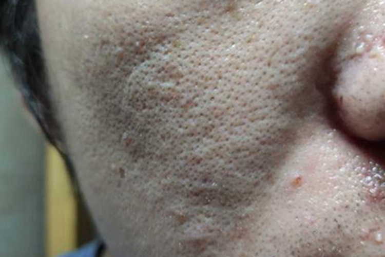 黑头脸部皮肤有黑点图 黑头脸部皮肤有黑点图