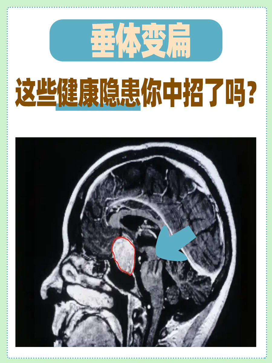 垂体变扁,这些健康隐患你中招了吗?