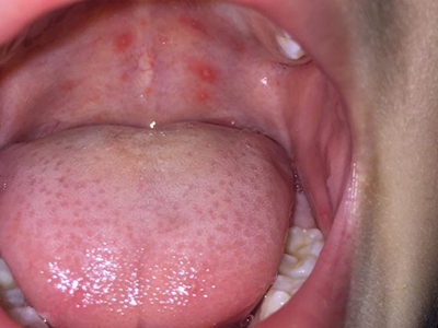 疱疹性咽峡炎咽峡周围有血点和小疱图