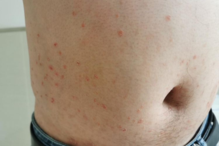 银屑病腹部红点图 银屑病腹部红点图