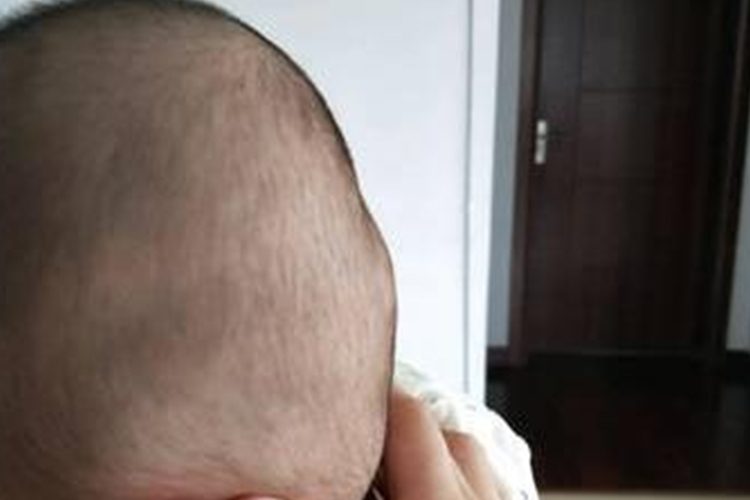 正常枕后隆突图