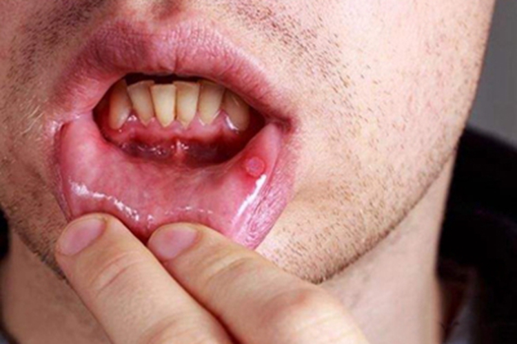 口腔溃疡初期图