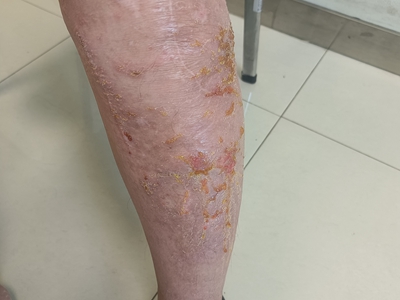 急性湿疹小腿皮肤流黄水结痂图jpeg