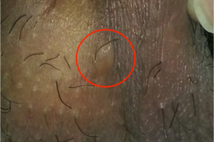 早期性病性淋巴肉芽肿症状图